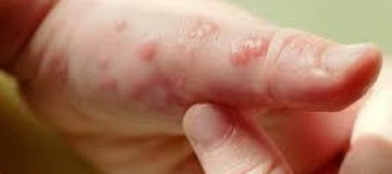 Pacientes com epidermólise bolhosa terão novo protocolo de cuidados