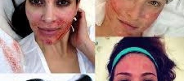 Técnica usa agulhas para tratar manchas e rejuvenescer a pele