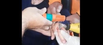 Idosa procura ajuda para serrar aliança que estrangulava o dedo
