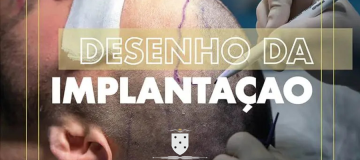Aumenta a procura masculina por Transplante Capilar - Clinica BREMEN