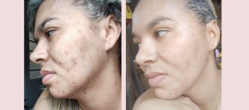 Concheça o Peeling do Mar Morto ou Rose de Mer - Dermicca Tratamentos