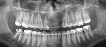 Cistos: Saúde bucal - Ceddro Radiologia e Tomografia digital