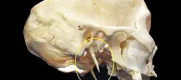 Síndrome de Eagle - CEDDRO Radiologia e Tomografia Digital