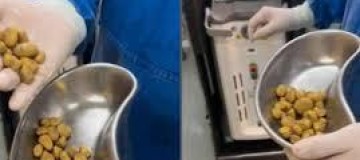 Médico retira 35 pedras da bexiga de idoso em MG