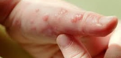 Pacientes com epidermólise bolhosa terão novo protocolo de cuidados