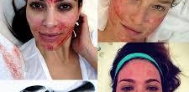 Técnica usa agulhas para tratar manchas e rejuvenescer a pele