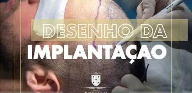 Aumenta a procura masculina por Transplante Capilar - Clinica BREMEN