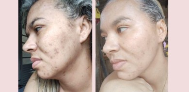 Concheça o Peeling do Mar Morto ou Rose de Mer - Dermicca Tratamentos