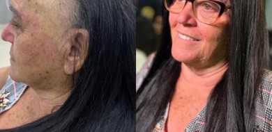 Técnicas capilares ajudam mulheres com alopecia a recuperar a autoestima