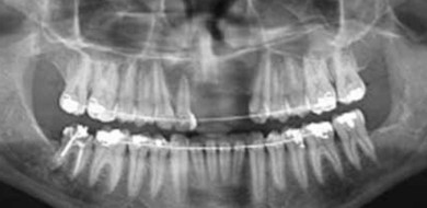 Cistos: Saúde bucal - Ceddro Radiologia e Tomografia digital