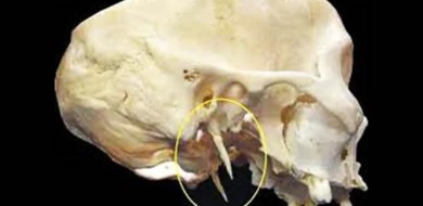 Síndrome de Eagle - CEDDRO Radiologia e Tomografia Digital