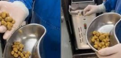 Médico retira 35 pedras da bexiga de idoso em MG